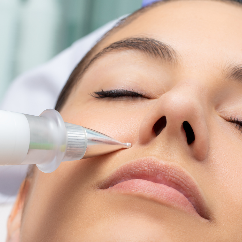 Fibroblast Plasma Skin Tightening procedure on Woman's face