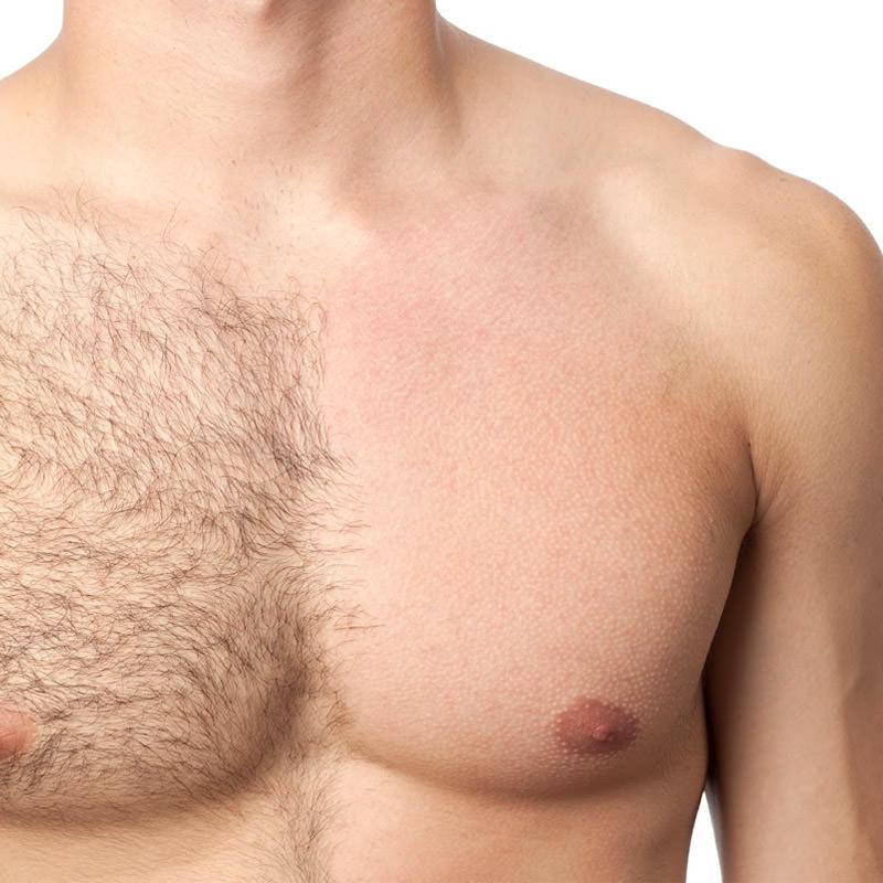 Laser hair removal on half of men's chest